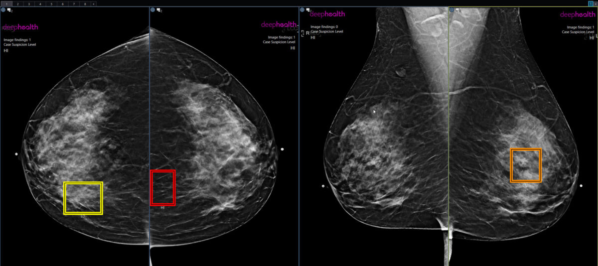 AI Diagnostics in Cancer Detection: What You Should Know